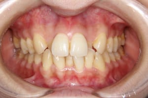 上の側切歯が口蓋側転位し逆被蓋です